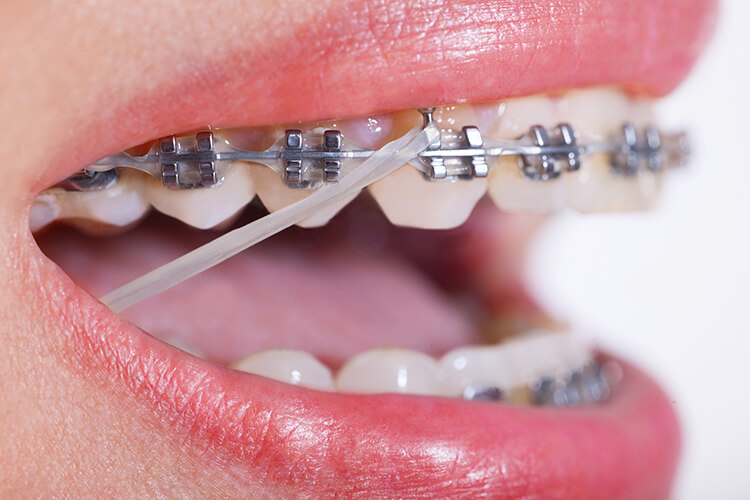 LES MINI-VIS EN ORTHODONTIE